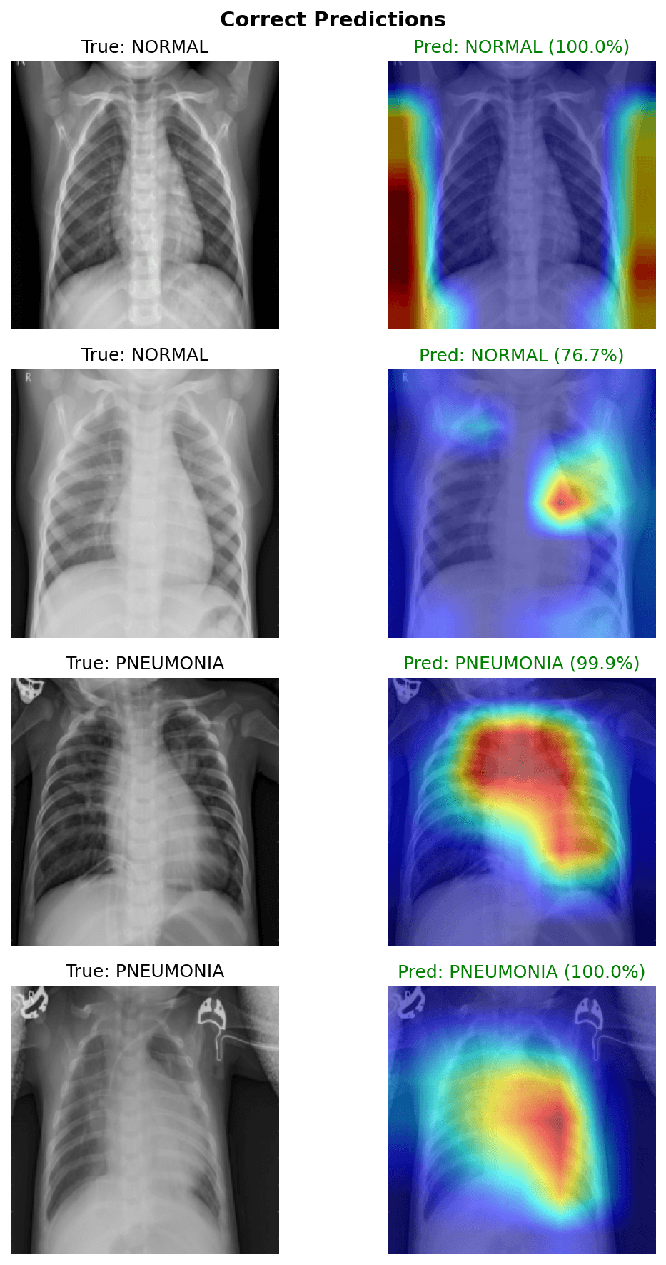 Four chest X-ray classification examples with original images, normal or pneumonia labels, model confidence values, and Grad-CAM overlays